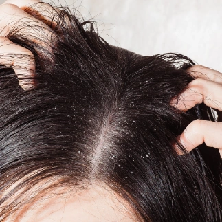dandruff treatment results